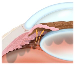 Peripheral Iridotomy | Eye Physicians and Surgeons of Ontario
